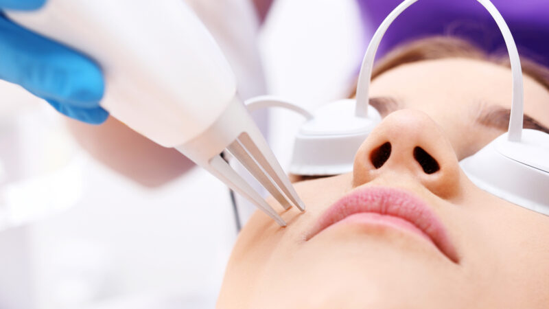 How Laser Treatment Can Help With Acne Scars